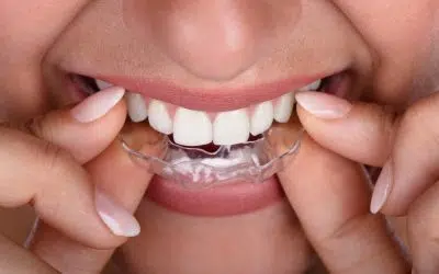 Are Clear Aligners Better Than Braces?