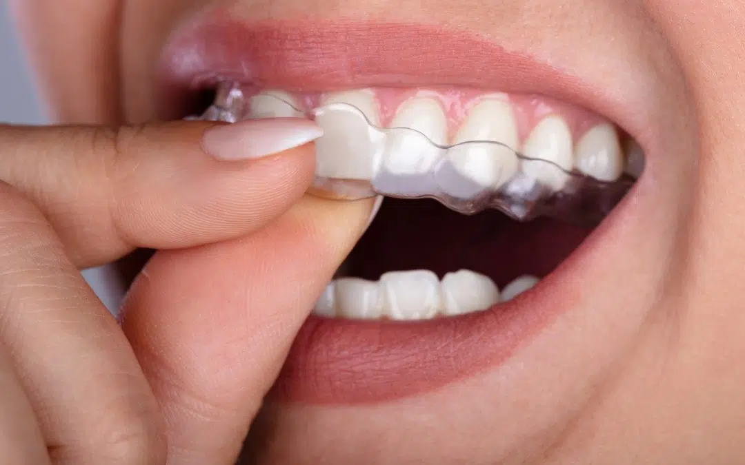 What Are DIY Clear Aligners?